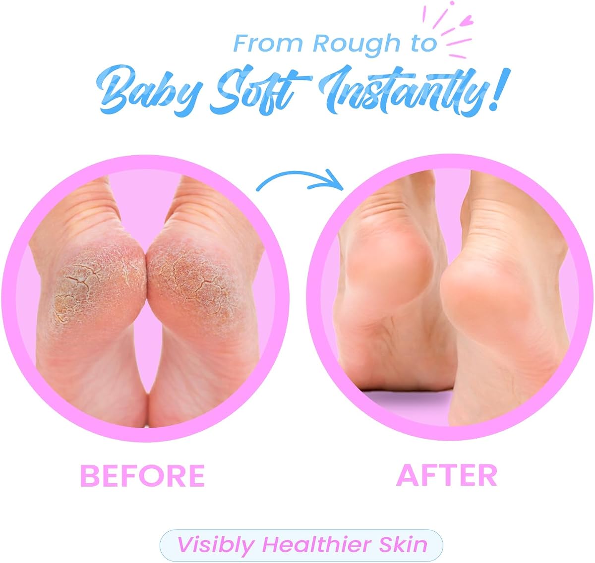 UrbanYog Callus Remover - 2-Speed, With 3 Roller Heads - 1 Unit - Image 4