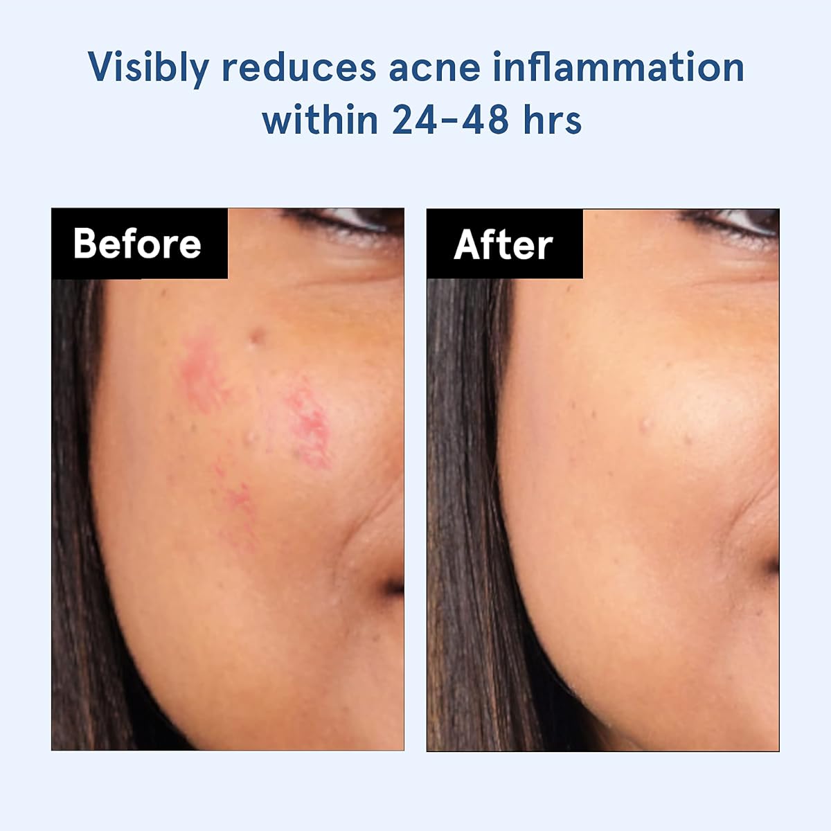 Be Bodywise Hydrocolloid Acne Pimple Patch - 24 Dots, 3 Sizes - Image 4