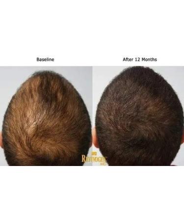 Revivogen MD Scalp Therapy One Month Supply 1 x 60ml