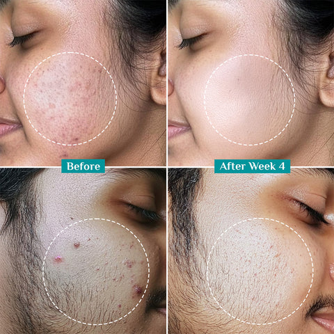 Pilgrim 2% Salicylic Acid Anti-Acne Face Serum- 30 ml