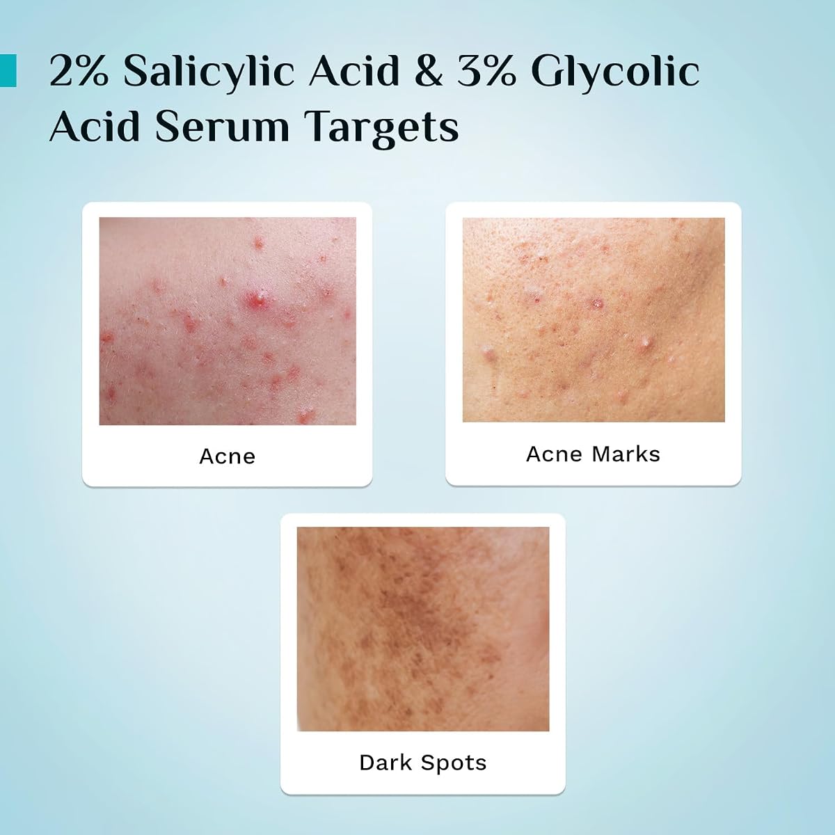 Pilgrim Anti-Acne Face Serum with 2% Salicylic Acid - 30ml - Image 4