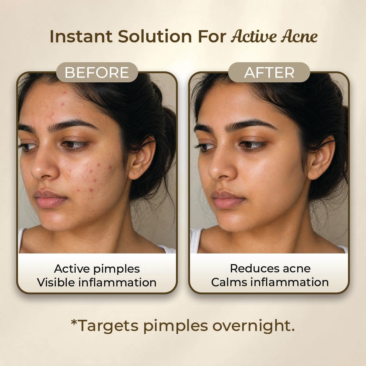 Sanfe Promise Face Acne Pimple Patch - Hydrocolloid Treatment, 36 Patches - Image 4