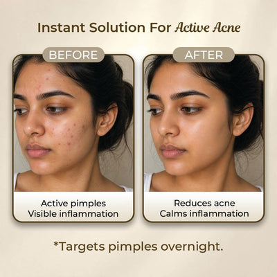Sanfe Promise Face Acne Pimple Patch - Hydrocolloid Treatment, 36 Patches - Image 4