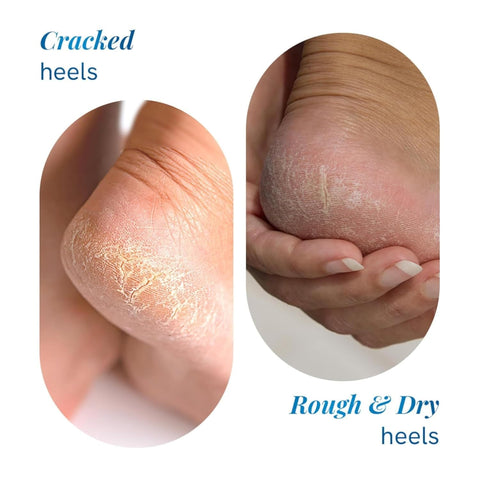 Bebodywise 20% Urea Foot Roll-On 75Ml