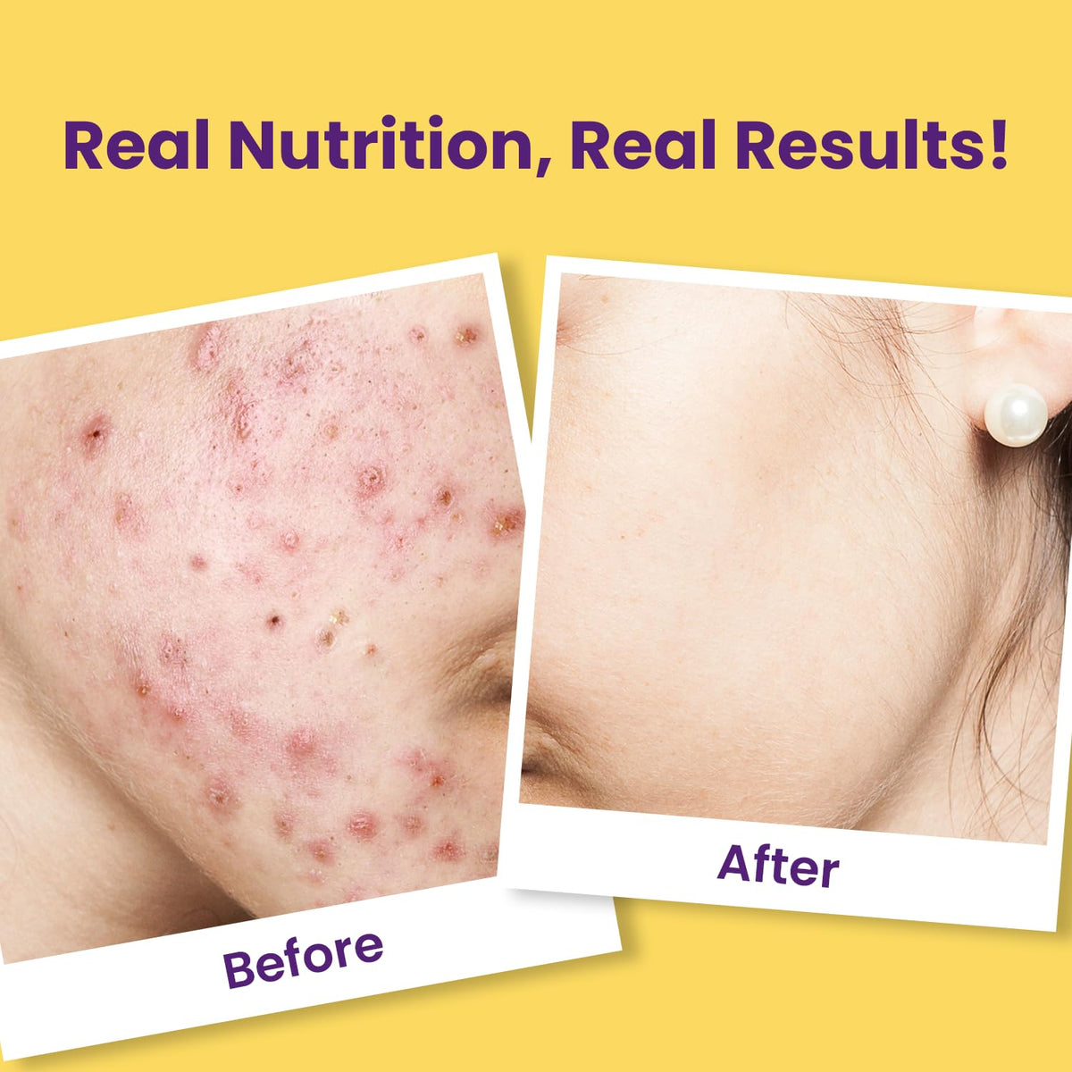 Chicnutrix Super C - Acne-Free Clear Skin Beauty Supplements - Image 5