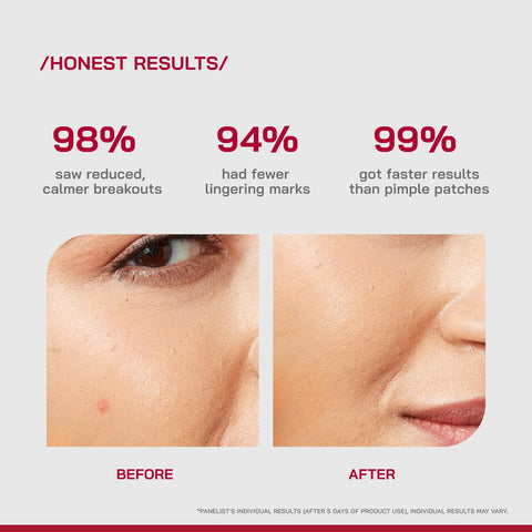 PHD Salicylic Acid Acne Spot Treatment Gel 10g
